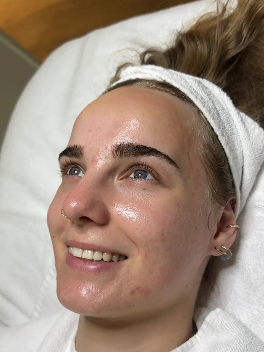 Fine nach mehreren Aknebehandlungen bei Beauty Concept Munich mit klarer, glowiger Haut