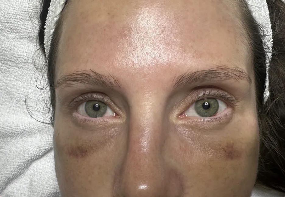 Augenpartie nach der manuellen Lymphdrainage mit deutlich abgeklungenen Schwellungen und Blutergüssen