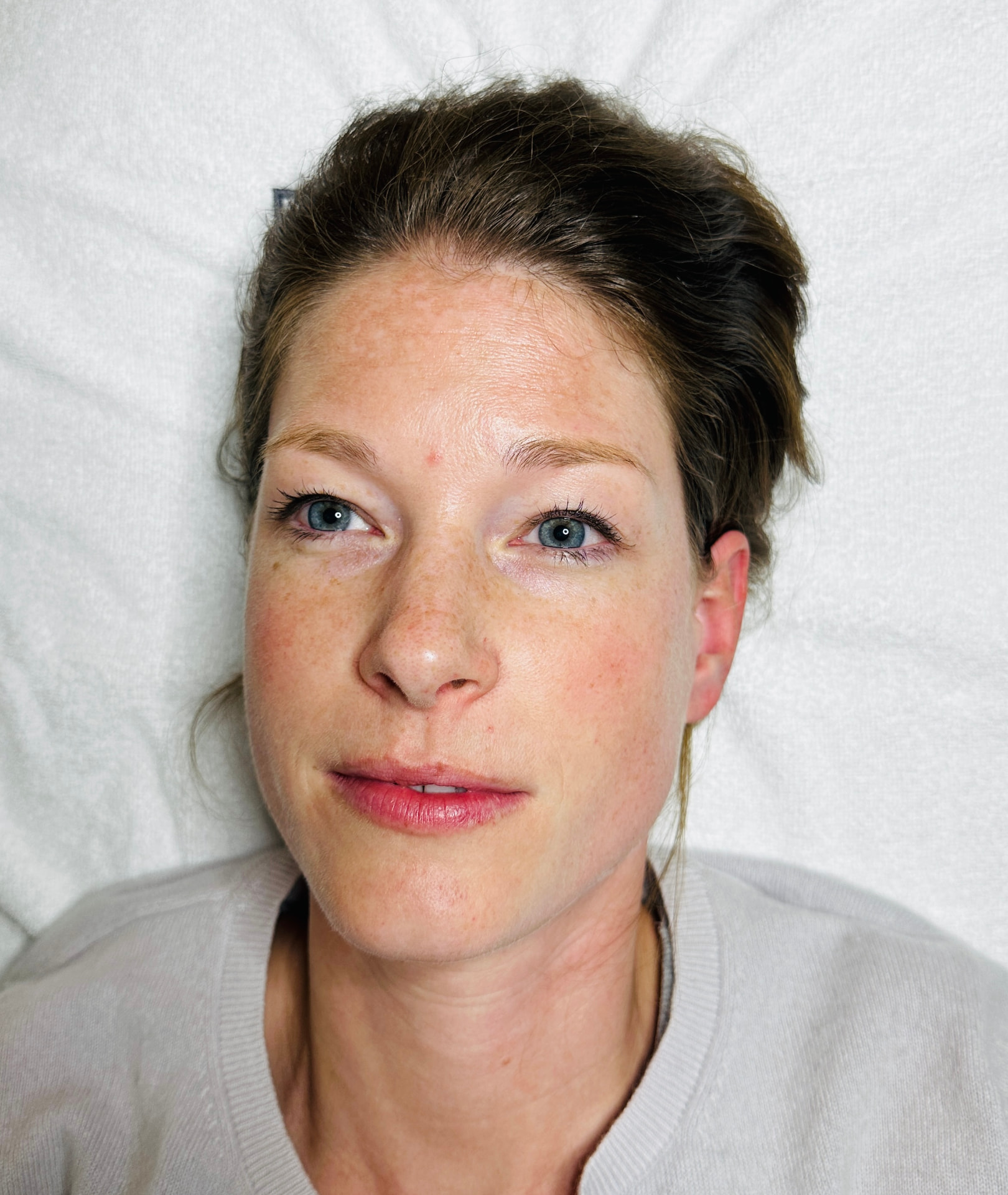 Luisa nach der Behandlung von Hyperpigmentierung bei Beauty Concept Munich mit ebenmäßigerem Hautbild